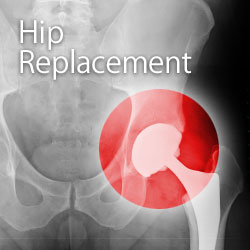 Depuy hip replacement recall